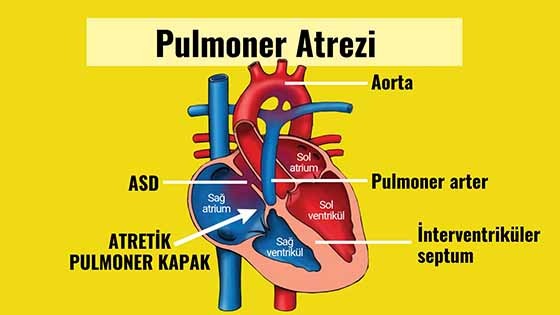 pulmoner atrezi intakt ventriküler septum