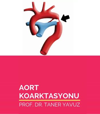 Aort Koarktasyonu