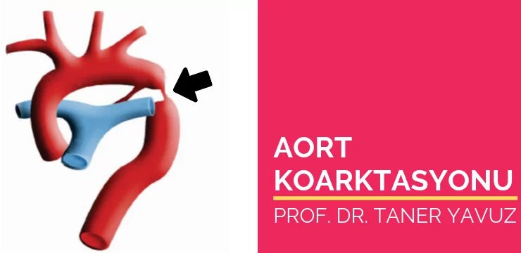 Aort Koarktasyonu
