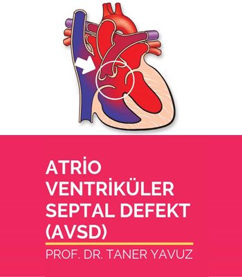 Atrioventriküler Septal Defekt (AVSD)