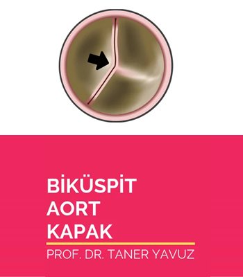 Biküspit Aort Kapak