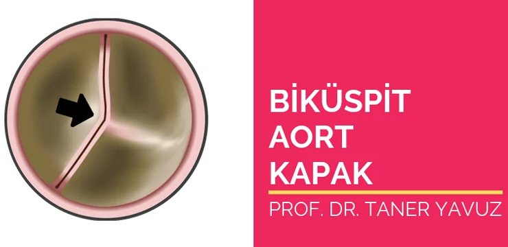 Biküspit Aort Kapak