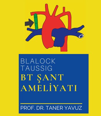 BT Şant (Blalock Taussig) Ameliyatı