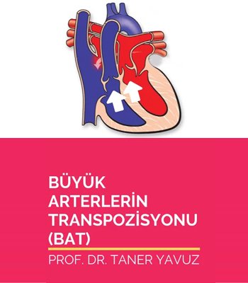 Büyük Arterlerin Transpozisyonu (TGA)