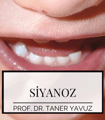 Çocuklarda Siyanoz (Morarma) Neden Olur?