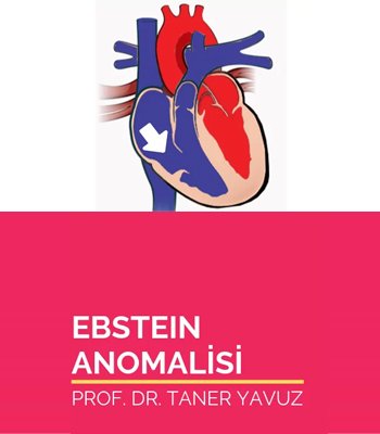 Ebstein Anomalisi