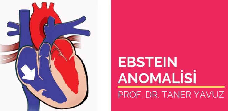 Ebstein Anomalisi