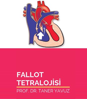 Fallot Tetralojisi (Mavi Bebek Hastalığı)