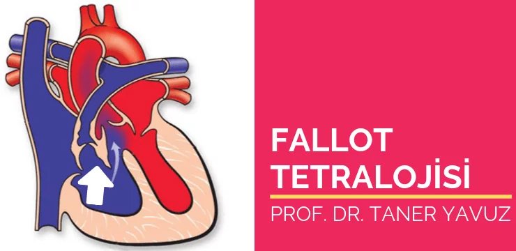 Fallot Tetralojisi (Mavi Bebek Hastalığı)