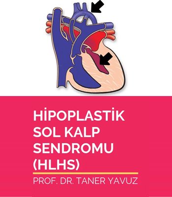Hipoplastik Sol Kalp Sendromu (HLHS)
