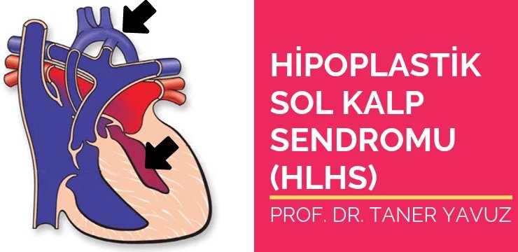 Hipoplastik Sol Kalp Sendromu (HLHS)