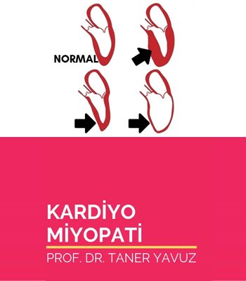 Kardiyomiyopati