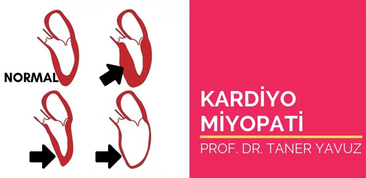 Kardiyomiyopati