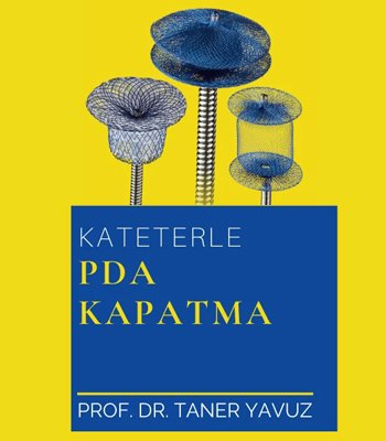 Kateterle Patent Duktus Arteriyozus (PDA) Kapatma