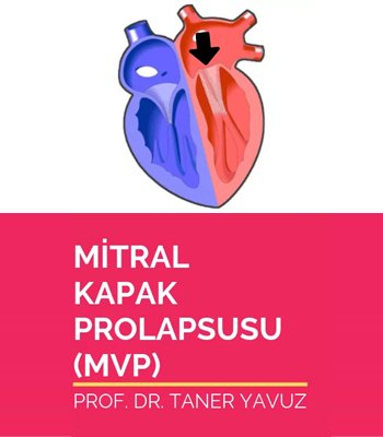 Mitral Kapak Prolapsusu (MVP)