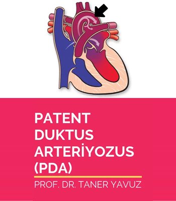 Patent Duktus Arteriozus (PDA)