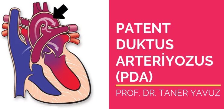 Patent Duktus Arteriozus (PDA)