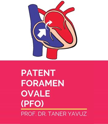 Patent Foramen Ovale (PFO)