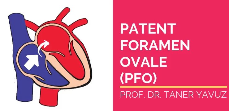 Patent Foramen Ovale (PFO)