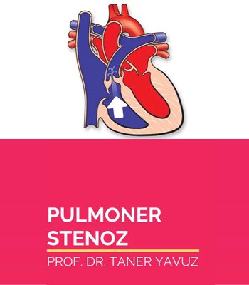Pulmoner Kapak Darlığı (Pulmoner Stenoz)