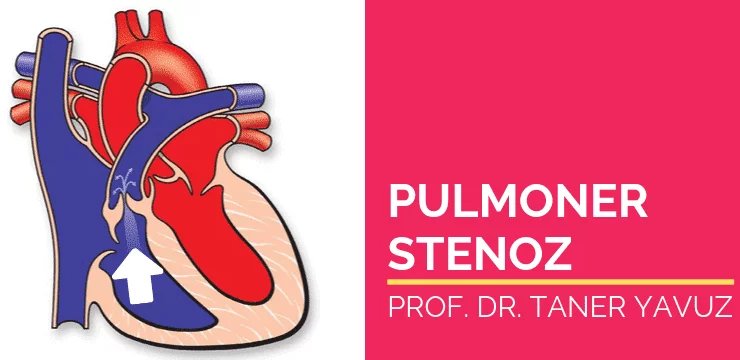 Pulmoner Kapak Darlığı (Pulmoner Stenoz)