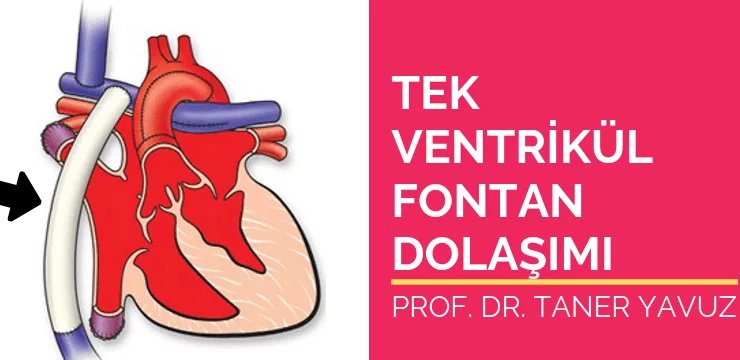 Tek Ventrikül ve Fontan Dolaşımı