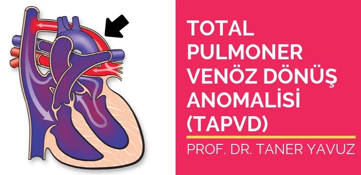 Total Pulmoner Venöz Dönüş Anomalisi (TAPVD)