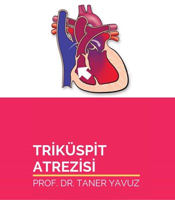 Triküspit Atrezisi