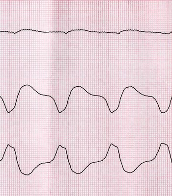 VSD (Ventriküler Septal Defekt) | Kalpte Delik