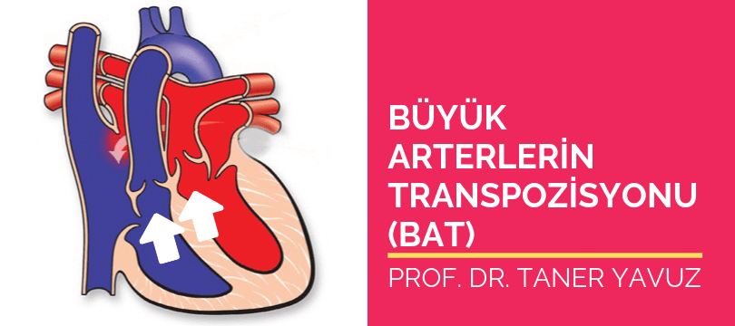 Büyük arterlerin transpozisyonu TGA