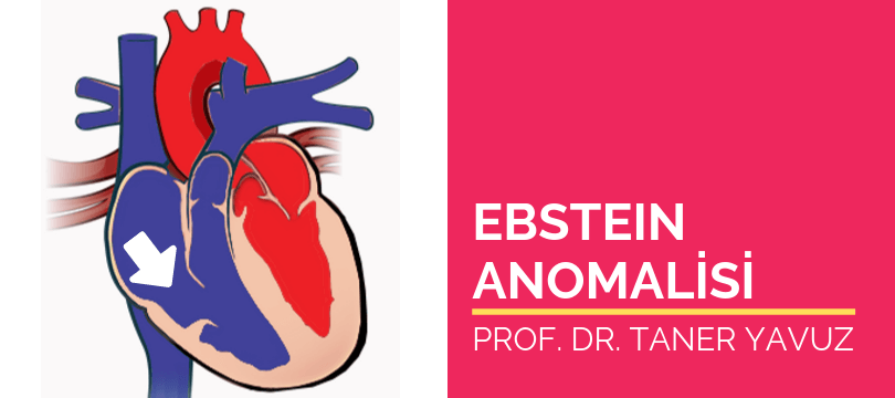 Ebstein anomalisi