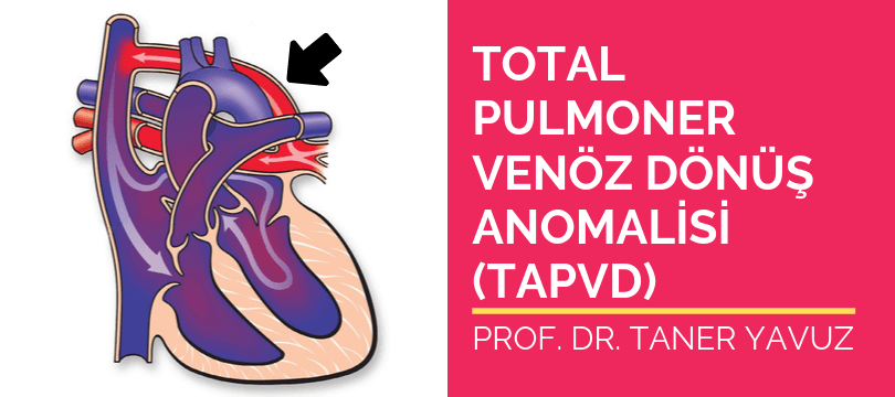 Total pulmoner venöz dönüş anomalisi TAPVD
