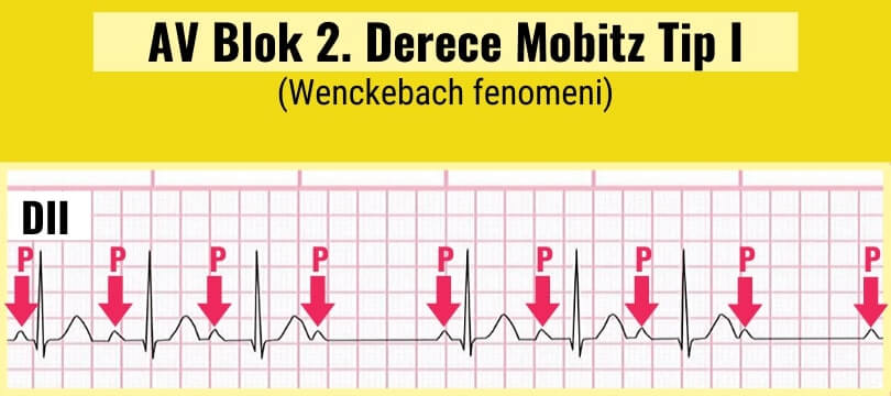 AV Blok 2. derece Mobitz Tip I