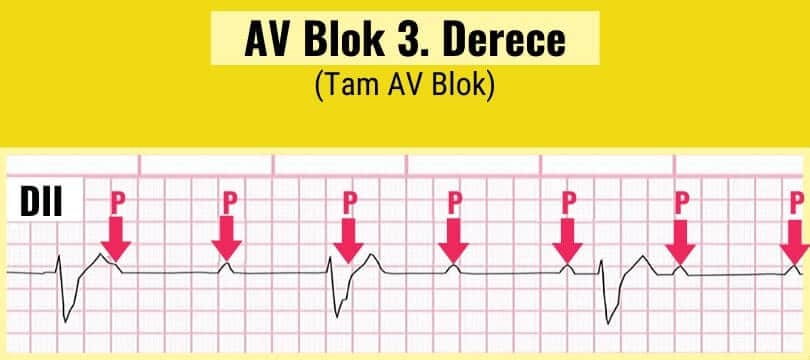 AV Blok 3. derece Tam AV Blok