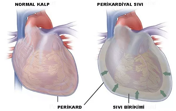 Perikardit