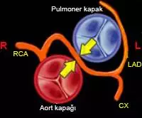 Koroner Arter Anomalileri