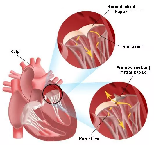 Mitral Kapak Prolapsusu (Çökmesi) - MVP