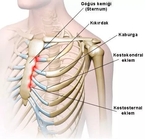 Kostokondrit göğüs ağrısında ağrı bölgeleri